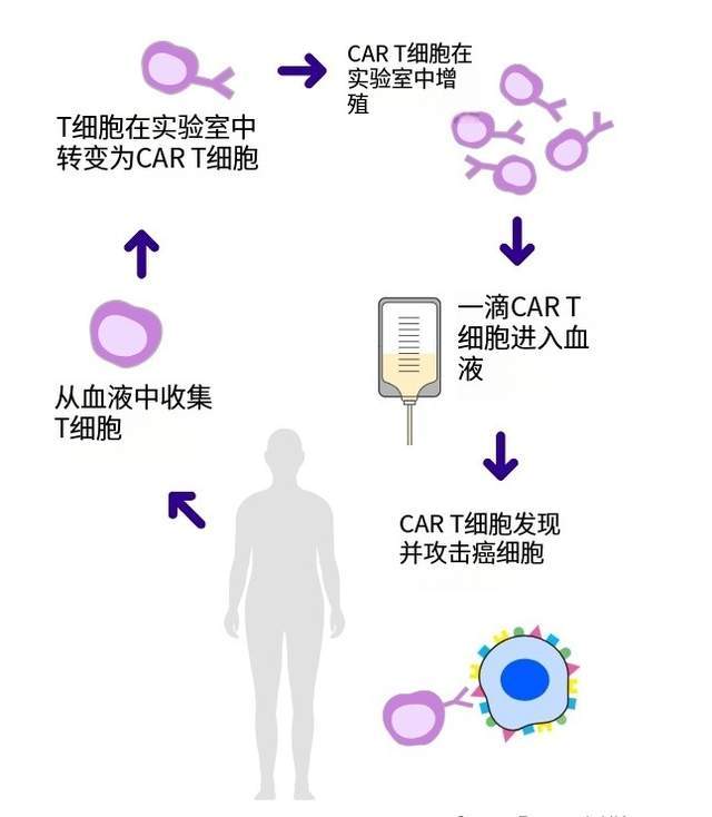CAR-T疗法显著提升晚期胃癌治疗效果