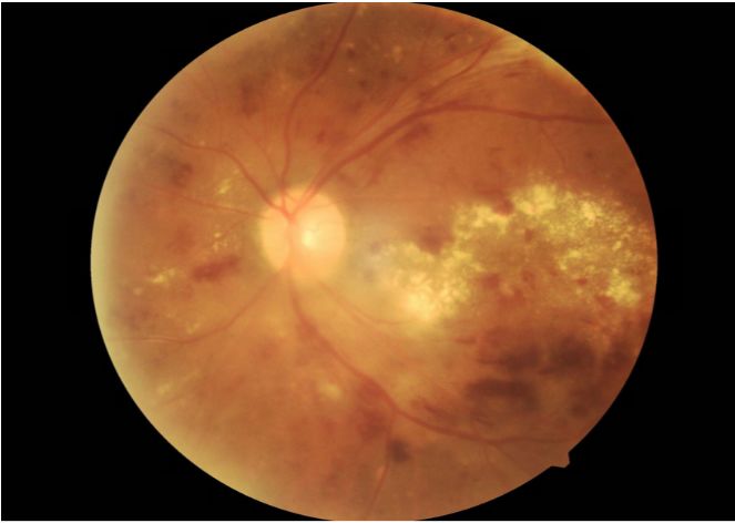 仁和药业:创新药RM301B适应症为视网膜静脉阻塞性黄斑水肿