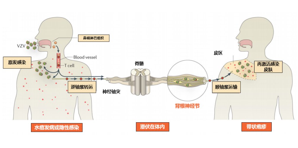 研究：带状疱疹疫苗可能降低心脏病及中风风险